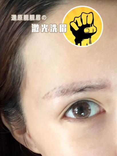 Laser Eyebrow Tattoo Removal|Eyebrow Semi-Permanent|Semi-Permanent Makeup|Hong Kong Semi-Permanent Makeup|Eyebrow Tattoo