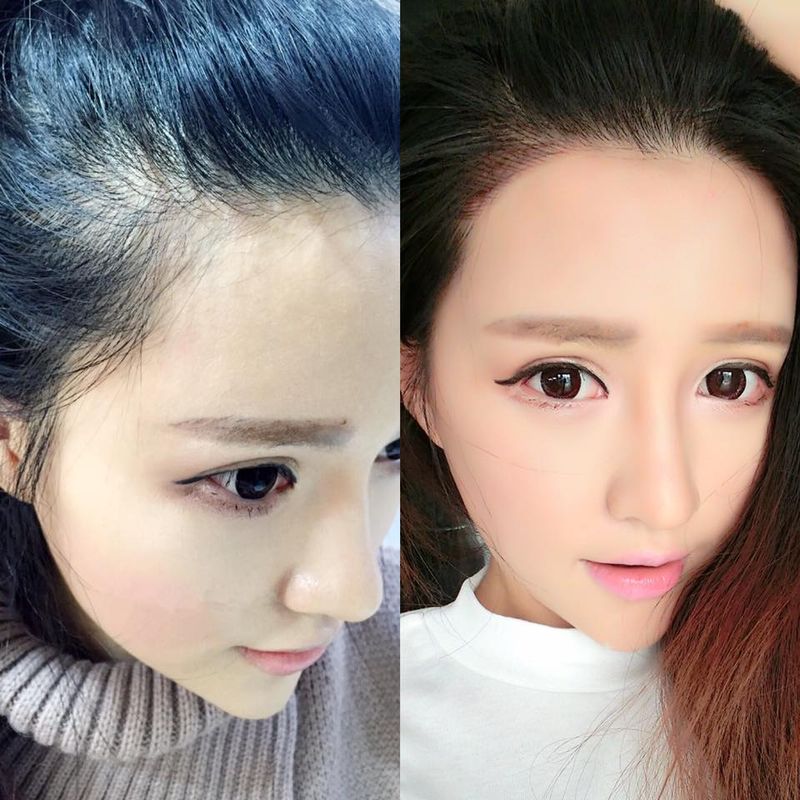 Model Leanna Korean Style Hairline Embroidery Comparison